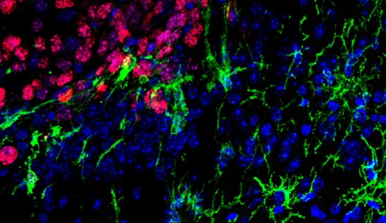 Descubren una nueva estrategia para combatir las metástasis cerebrales de melanoma
