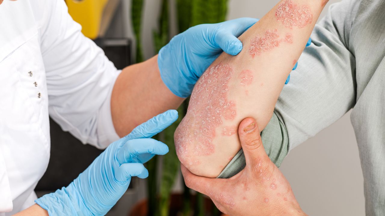 Nuevos avances en el tratamiento de la psoriasis: terapias innovadoras y personalizadas