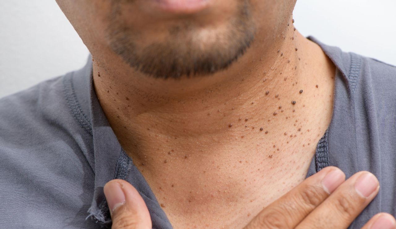 Queratosis actínica: una lesión precancerosa frecuente con múltiples opciones terapéuticas